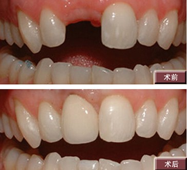 北京圣贝口腔医院种植牙对比案例图