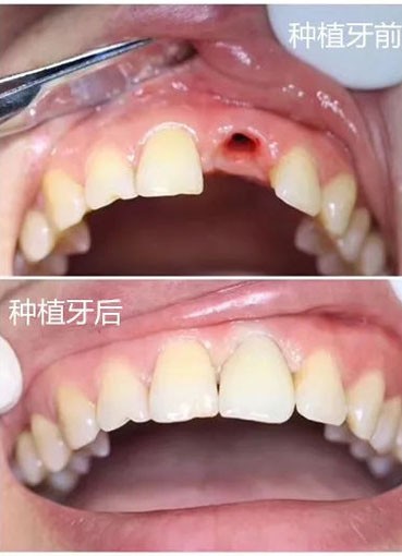 26岁小姐姐在青岛拜博做韩国登腾种植牙的经历