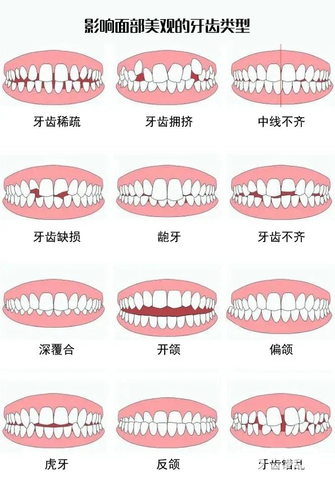 牙齿类型示意图