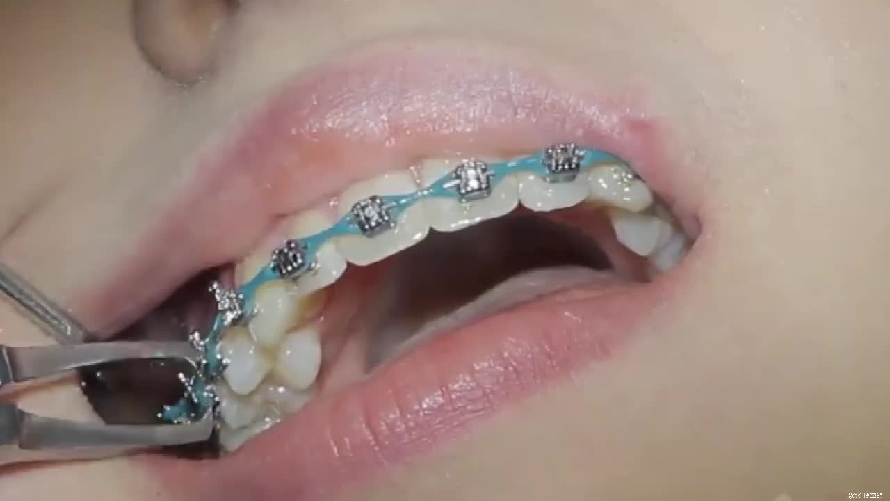你知道牙套是如何从牙齿上摘下来的吗？