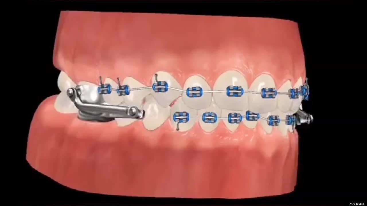 传统金属牙套是如何矫正龅牙的？