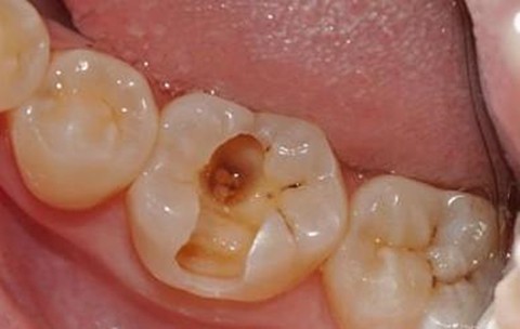 蛀牙已经烂空了怎么办？补牙和根管治疗选哪个好？