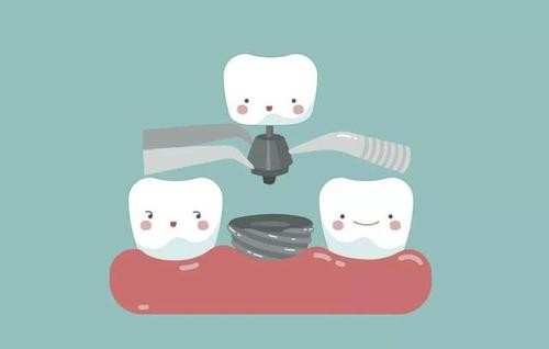 德国种植牙和瑞士种植牙有什么区别？选哪个比较好？