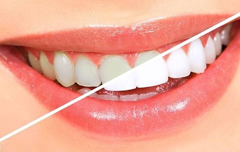 洗牙可以美白牙齿吗？牙齿变白有效的方法是什么？