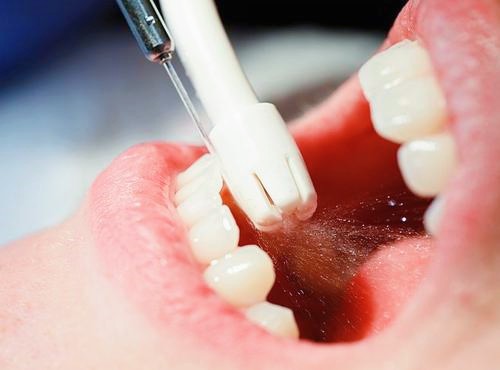 北京洗牙最好医院排名评选：多少钱？可以用医保吗？