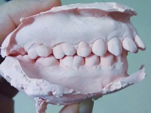 美容冠可以矫正龅牙吗？门牙突出最快矫正方法是什么？