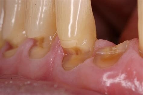 刷牙导致的楔状缺损真的会让牙齿断掉