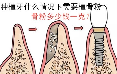 种植牙什么情况需要植骨粉？种植牙植骨粉多少钱一克？