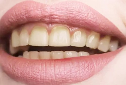 上千元的冷光美白对牙齿有副作用吗？效果到底如何？