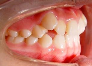 长歪的虎牙可以矫正吗？上海正畸虎牙的牙科有推荐吗？