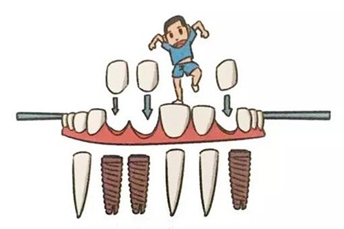种植牙对身体有危害吗？都在说的种牙五大危害是什么？