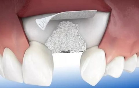 牙齿什么情况下需要植骨粉？种植牙骨胶原和骨粉的区别有哪些