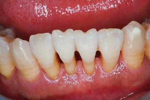 牙医不会告诉你的秘密:牙周炎引起牙龈萎缩怎么补救?