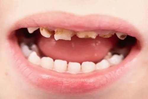 福州儿童医院补牙多少钱？口碑好的牙科有哪些？