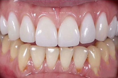 牙齿黄怎么快速变白？还在看网上的在家自己美白牙齿的小妙招？