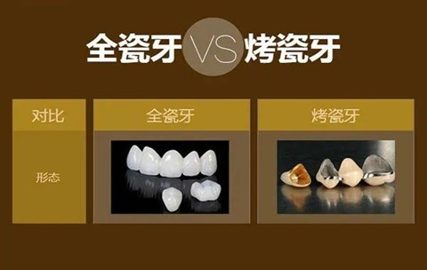 全瓷牙和烤瓷牙哪个好？1200元一颗的全瓷牙能做吗？