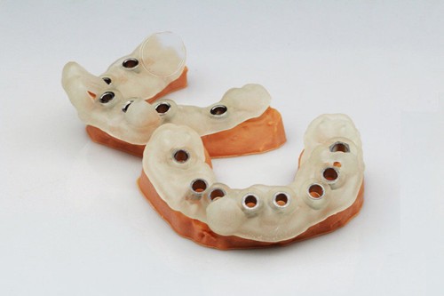 导板种植牙与普通种植牙区别是？种植牙导板额外收费吗？