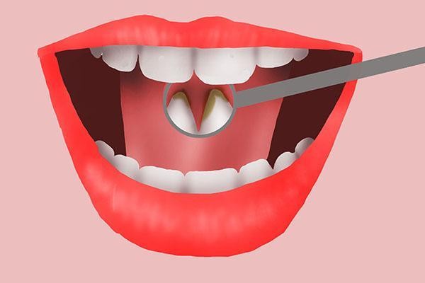 牙齿缝隙有黑黑的抠不下来，这些方法可以帮你祛除黑线