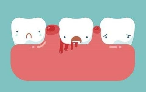 牙龈出血怎么办？教你快速制止牙龈出血小妙招和注意事项
