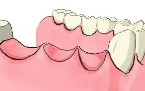 缺失6颗牙齿镶牙还是种牙？咨询所有医院还是决定做种植牙