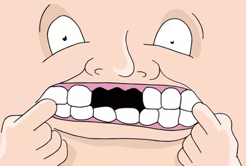 求助：20多岁牙齿掉了怎么办？是镶牙好还是做种植牙好？