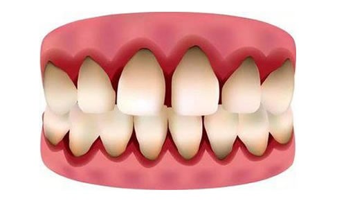 如何预防牙龈萎缩？民间偏方有办法可以让牙龈再长回来吗