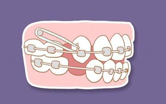 牙齿矫正方案中的扩弓、支抗钉、片切，你明白是什么吗？