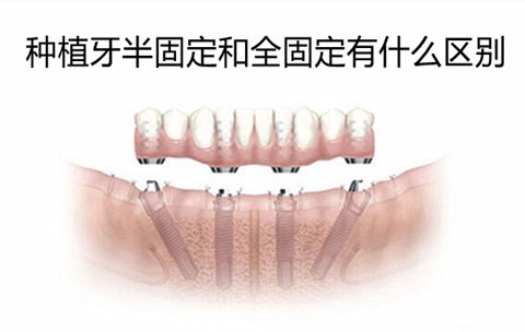 种植牙半固定和全固定区别是什么？烟台哪家牙科做种植牙好