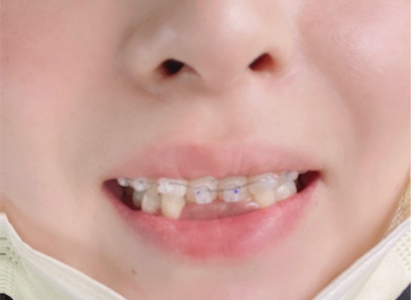 2021年牙齿矫正价格表公示：含12-40岁各种牙套所需费用