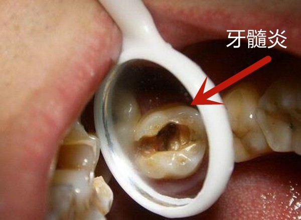 被忽悠做了根管治疗，牙齿做根管治疗后牙疼怎么办？