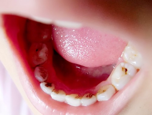 不同年龄段的儿童，怎么保护牙齿健康