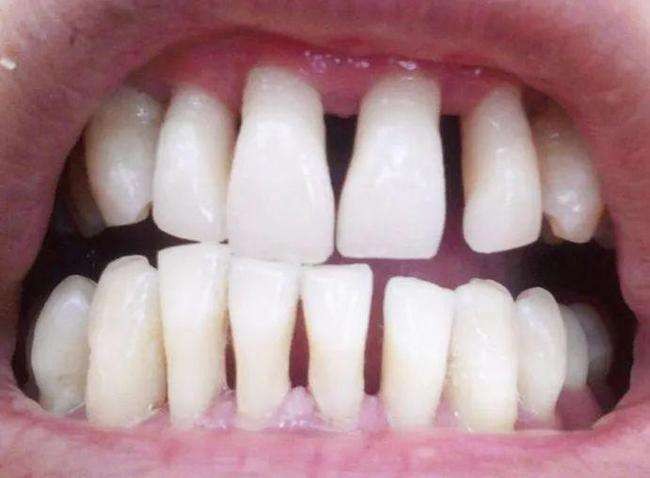 40岁牙齿缝隙越来越大了,有人知道牙齿缝隙大怎么解决吗?