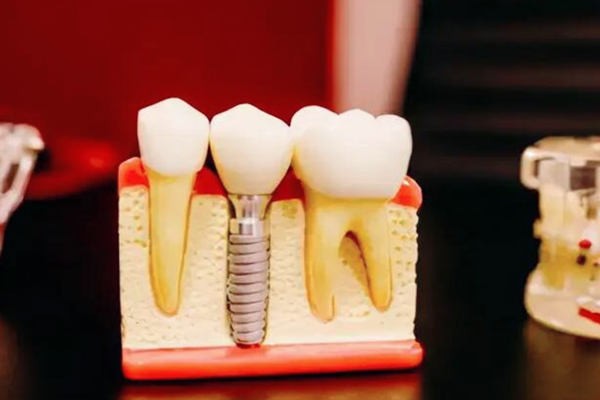 种植牙列入医疗集中采集了吗?看新规就知道种植牙医保吗?