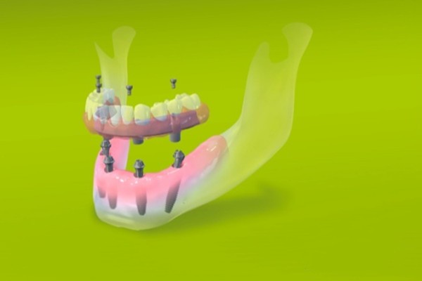 今年种植牙有望降价,医保局发布种植牙价格调控目标为4500元/颗