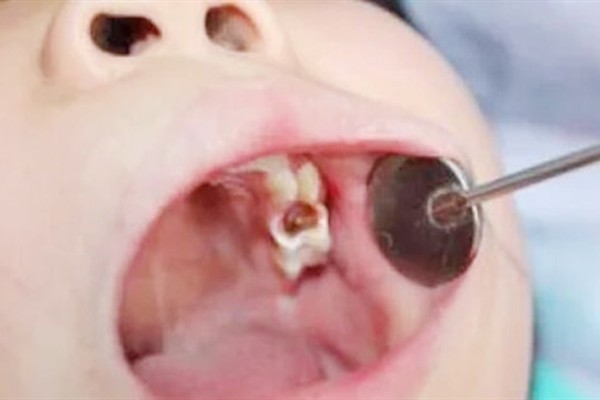 孩子乳牙有牙洞需要补吗？良心医生是这么说的