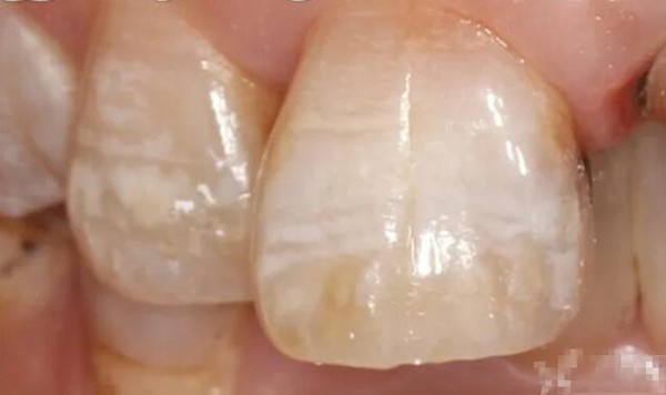 氟斑牙能做牙齿瓷贴面美白吗?哪个品牌的瓷贴面更经济实惠些?
