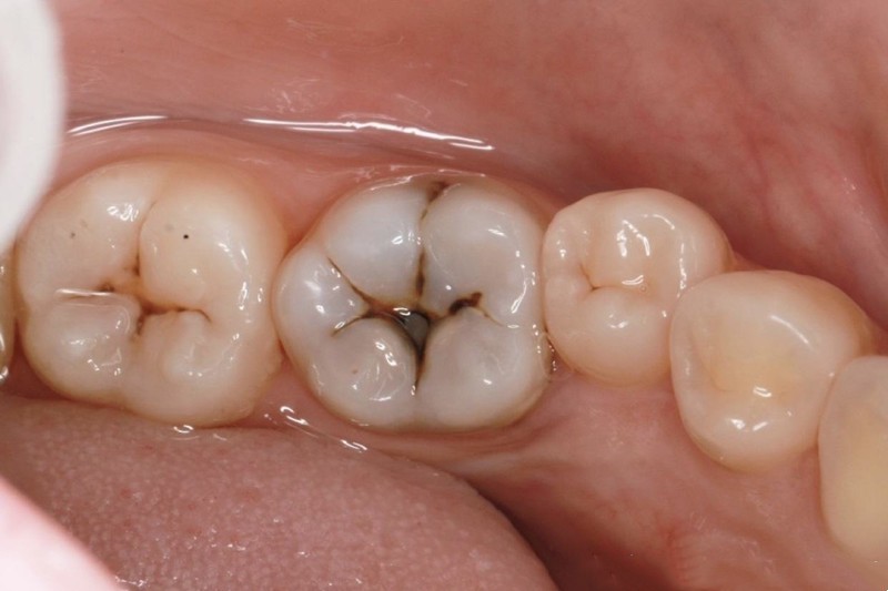 了解完补牙的全过程，其实补牙没那么可怕
