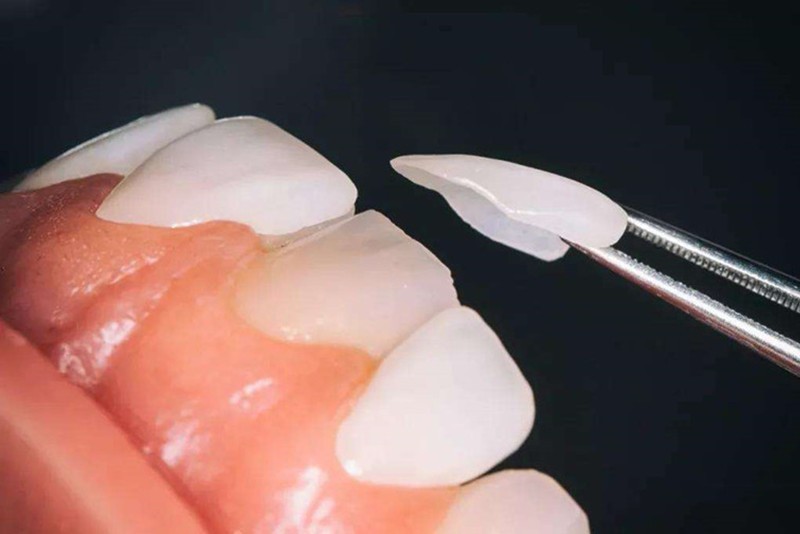 牙齿做完瓷贴面后，如何延长瓷贴面的使用寿命？