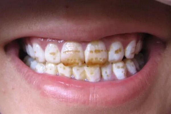 图片介绍四环素牙和氟斑牙区别，看完还不懂过来找我