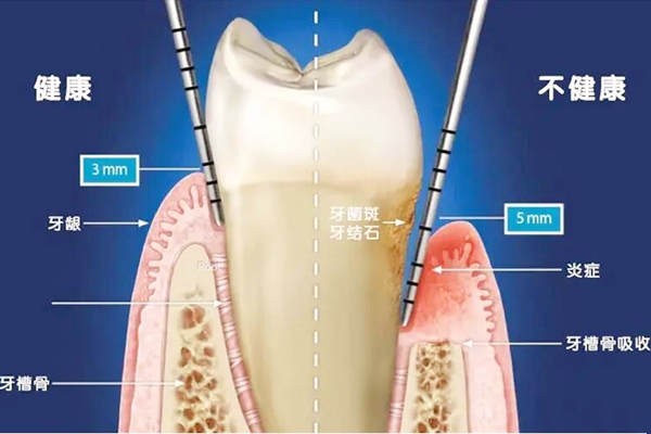 杭州口腔医院牙周炎治疗价格是多少钱?洗牙300/刮治4000-5000元不等
