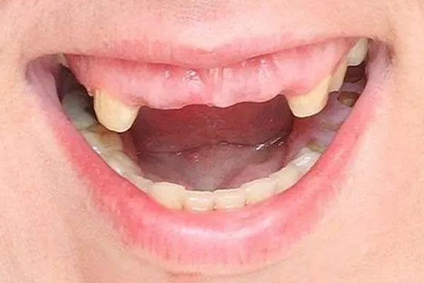 种牙与镶牙有什么区别哪个好一些，更想知道装牙装什么牙最划算