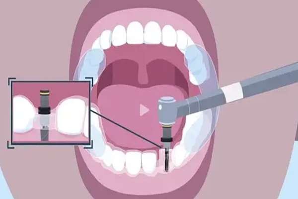 种植牙较难受的环节是哪一步？种植牙打孔的时候没想象那么痛