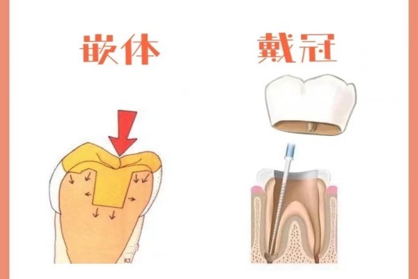 做嵌体和牙冠哪个寿命长？看完你便明白如何选择牙冠和嵌体