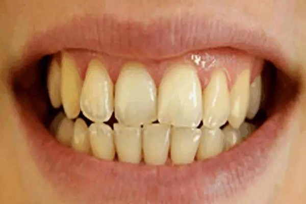 为什么经常刷牙还牙黄？超过八亿人都在假刷牙