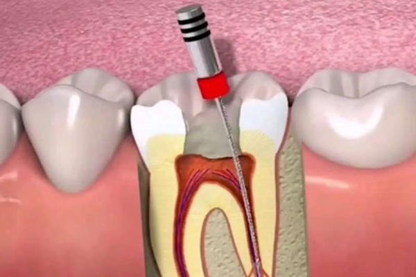 医生我想问问：牙齿做根管治疗是不是就废了？