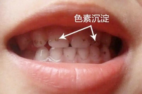 儿童牙齿黑色污垢怎么去除?2分钟解答牙齿上有黑渍怎么去除